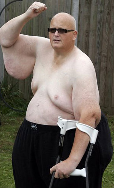 Şimdi kilosu sabit bir duruma gelene kadar ameliyat olmayacak.