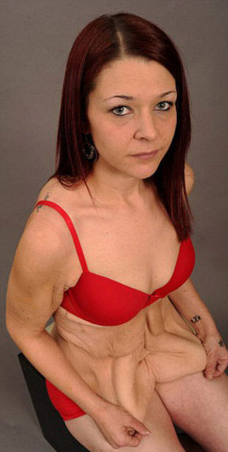 Ulusal Sağlık Sistemi NHS tarafından da fazla derilerinin operasyonla alınması reddedilen ve ameliyatı karşılayacak parası da olmadığından ortada kalan Miles, tek çaresinin yeniden kilo almak olduğunu dile getirdi.