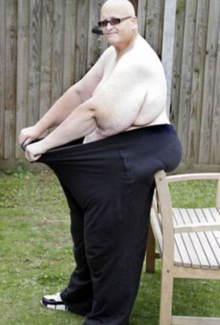 İki yılda iki ameliyat geçirerek yağları alındı.