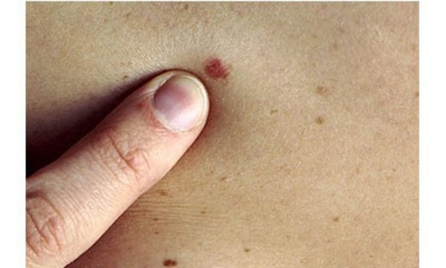 Renk, şekil ve büyüklüğü değişen, çabuk kanayan veya ülserleşen benler, - İyileşmeyen yaralar varsa, - Ve uzun süreli güneş ışığına maruz kalıyorsanız. -