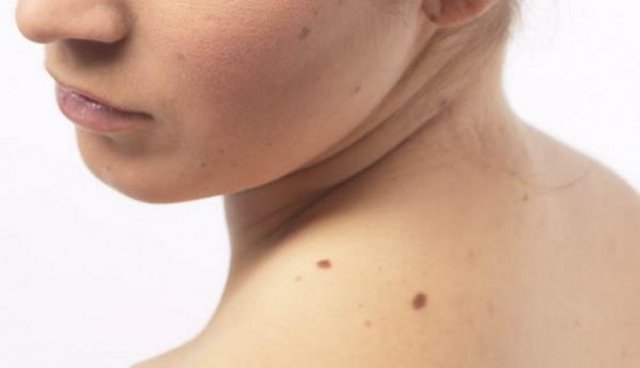 Bu belirti özellikle pankreas, mide, gırtlak veya akciğer kanserinde görülüyor.