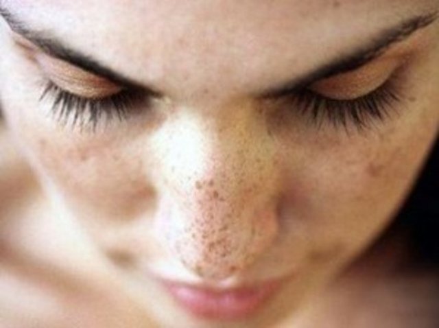 5 - Yutkunma problemi ve kronik ses kısıklığı: Bunlar dudaklarda iyileşmeyen yaralar, sıradışı kanamalar, ağızda ağrı ve uyuşma, kronik gırtlak iltihabı, ağız kanserinin belirtileri olabilir.