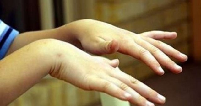 Stres, yoğun çay ve kahve içmek, açlık, yorgunluk, ani sinirlenme gibi bazı durumlar titremeyi fark edilir hale getirebilir. Bu faktör ortadan kalkınca kişi eski haline dönebilmektedir.