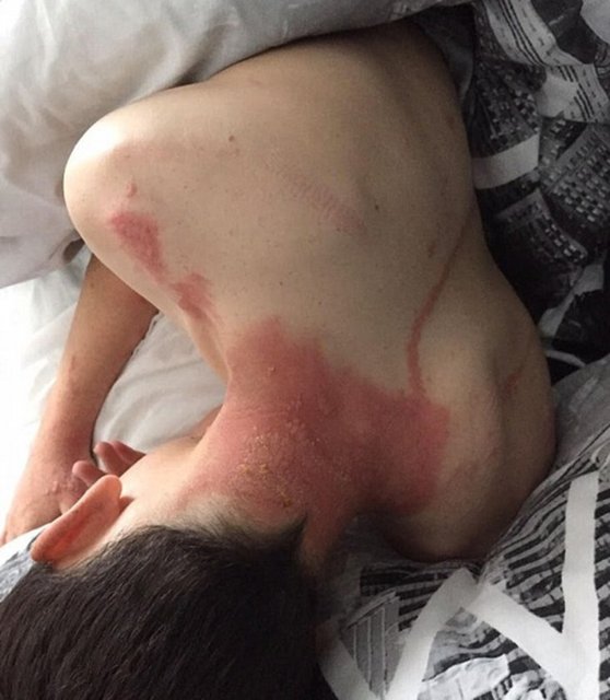 Doktorlar, vücuttaki kızarıkları ilk gördüklerinde sebebi belli olmayan alerjik reaksiyon teşhisi koyup aileleri evine gönderdi.