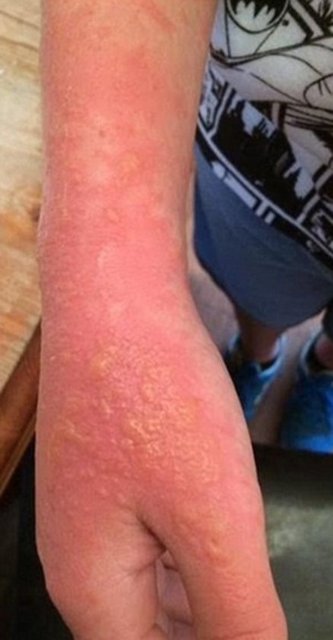 Çocuklardan birinin babası, "Çocuğum acı içinde bağırıyordu ve doktorların ne olduğu hakkında fikri yoktu. İlk başta kızarıklarla başladı, sonra döküntüleri gördüm. 48 saat sonunda ise kabarcıklar oluşmaya başladı çocuğumun vücudunda" dedi.