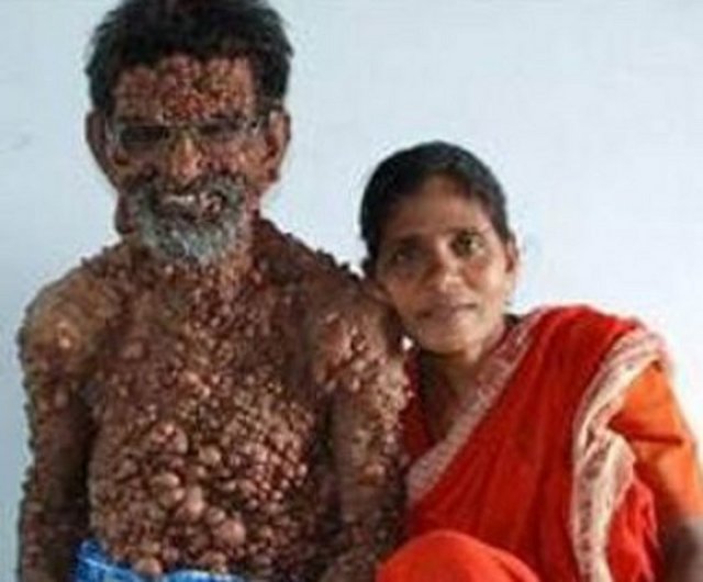 Hindistan'da bir tümör bozukluğundan dolayı vücudunun neredeyse yüzde doksanı kabarcıklarla kaplı olan 62 yaşındaki Muhammed Umar, aslında çok mutlu biri.