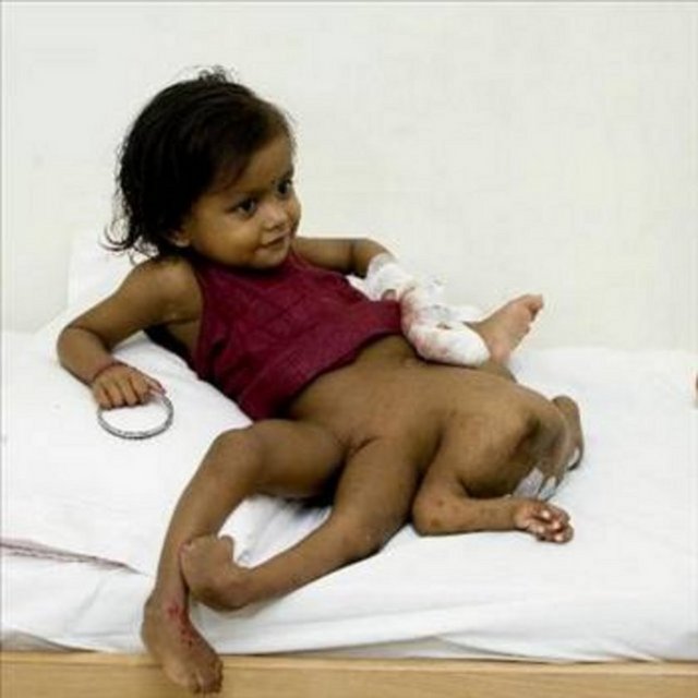 8 BACAKLI KIZ -  - 2005 yılında Hindistan'ın fakir bir köyünde dünyaya gelen küçük kız herkesi şaşırtmayı başardı. Dört kollu ve dört bacaklı olarak dünyaya gelen Lakshmi Tatma, 30 ameliyat geçirdi. Küçük kızın hala geçirmesi gereken ameliyatlar var.