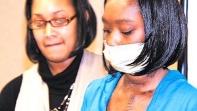 Doktorlar bu yeni organı çıkarmak zorunda kaldı, ancak yeni bir kalp olmadığı ve D'Zhana ameliyattan sonra güçsüzleştiği için geçici bir önlem alınması gerekti. 4 ay boyunca iki yapay pompa vücudundaki kan akışını gerçekleştirdi.