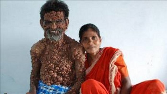 HİKAYESİ YÜREK BURKTU -  - Bir tümör bozukluğundan dolayı vücudunun yüzde doksanı kabarcıklarla kaplı olan 62 yaşındaki Hintli Muhammed, zorlukları eşinin sayesinde aşmış.