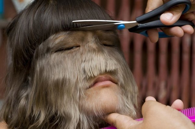 Bu küçük kız, ortaçağlardan beri kayıtlara geçmiş olan sadece 50 kişide görülmüş olan Ambras sendromunun pençesinde.