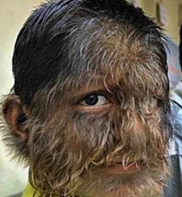 Pruthviraj Patil Hipertrikoz sendromu ile Hindistan'ın Mumbai yakınlarındaki Sangali bölgesinde dünyaya geldi.