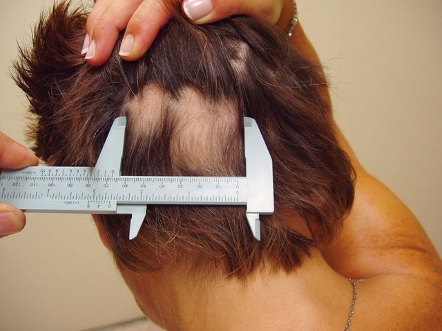 Alopecia Areata: Belirti vermeden sınırları belirgin küçük dairesel yamalar şeklinde oluşan saç dökülmesi