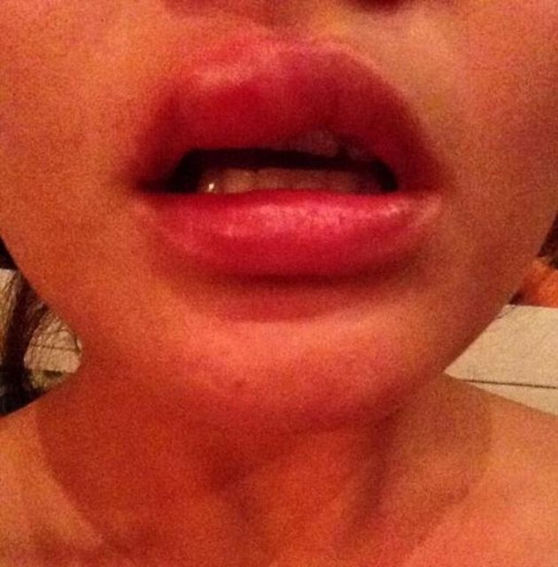 Teigen, daha önce de şişmiş dudağının fotoğrafını Instagram sayfasında paylaşmıştı.