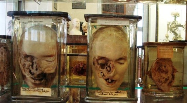 Tıbbi anormalliklerin vücut üzerine nasıl etkiler bıraktığını gösteren balmumundan yapılan insan kafaları.