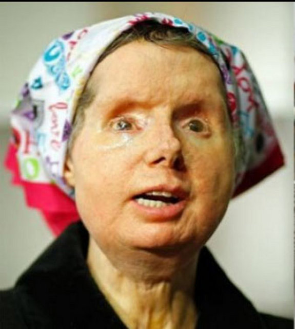 Yüzünü kaybeden şanssız kadına 2011 yılında yüz nakli yapılmıştı. Doktorlar, fizik terapistleri, hemşireler, psikologlardan oluşan 30 kişilik bir uzman ekip tarafından hayata döndürülen Charla Nash'e yüz nakli ameliyatından sonra cam gözler takıldı.