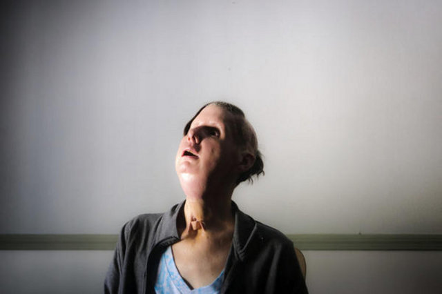 Saldırıda elleri, burnu, dudakları ve gözkapaklarını kaybeden kadın aradan geçen 4 yılın ardından yüzüne kavuşabildi.