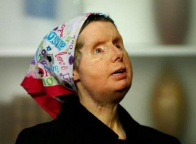 Ellerini kullanamayan şanssız kadın yüzünün sadece alt bölümünü fonksiyonel bir şekilde kullanabiliyor.