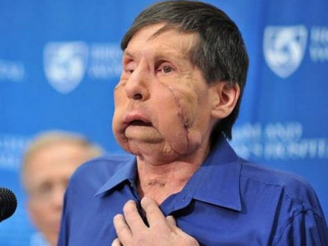 Yaşadığı korkunç tecrübenin ardından yüz nakli, bir dizi ameliyat ve estetik operasyon geçiren Charla Nash 4 yıl sonra günlük hayata adapte olmaya çalışıyor.