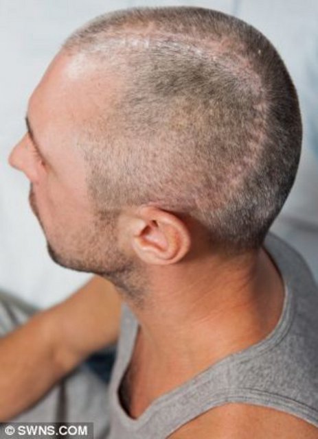 Bilincim yerine geldiğinde neler olduğunu hatırlamıyordum. Sadece kafamdaki çöküğü hissettim' diyerek yaşadıklarını anlattı.