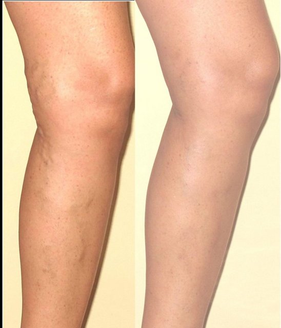 Skin tyte, cilt sıkılaşmasında, karın bölgesindeki sarkmalarda, dekolte, boyun, eller ve kol bölgesi sıkılaştırmada, cilt renk düzenleme ve dengelemede oldukça etkili.