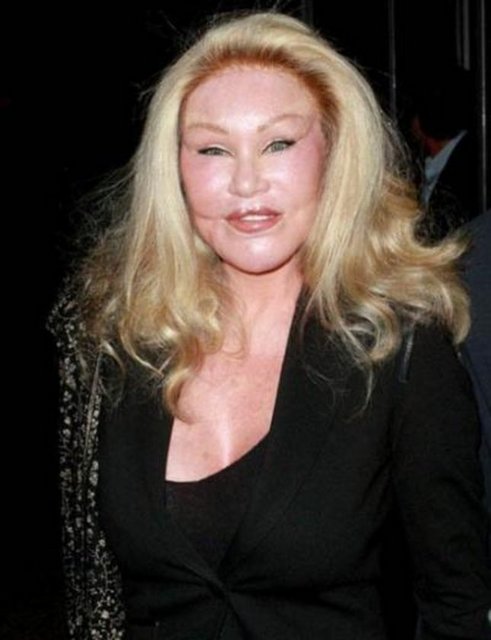 Jocelyn Wildenstein ya da daha çok bilinen adıyla Kedi Kadın sadece botoks değil her tür estetik operasyon yaptırıyor.  -