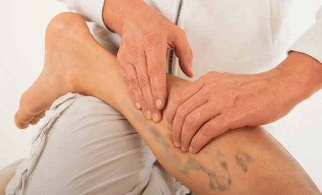 Ailesinde varis problemi olan bir kişi sürekli ayakta kalması gereken veya hareketsiz oturması gereken bir mesleğe sahipse, sigara kullanıyorsa, aşırı sıcağa maruz kalıyorsa varis problemi ile karşı karşıyadır.