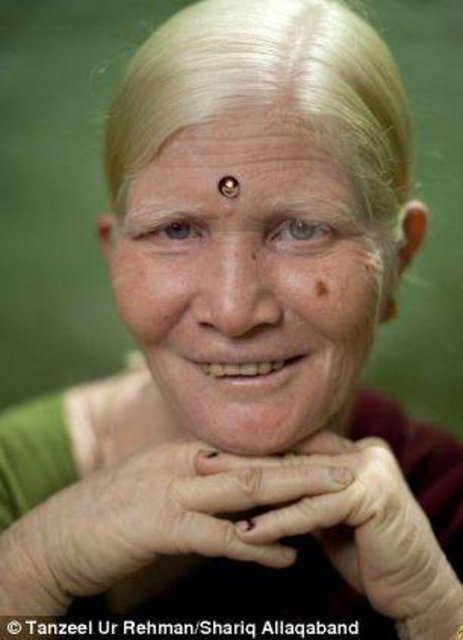 Albino hastalarının derilerinde melanin pigmenti çok az oluyor. Bu da tenlerinin beyaz görünmesine sebep oluyor...