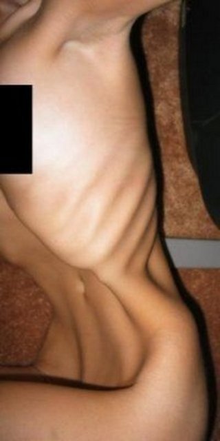 Hastalığın adı ise, Anoreksiya Nervoza, özellikle genç kadınlarda görülebilen, yemek yememek, çok az uyumak, buna rağmen çok aktif olmakla beliren psikolojik bozukluk.