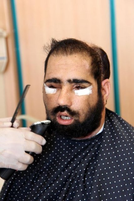 Bunun nedenin de hastanın başka problemlerinin oluşmaya başlaması olduğunu ifade eden Özkan, "Bunlar dahili problem. Ama sonuçta bizim yaptığımız yüz naklinden sonra da o yüz dokusunun ileride problem yaratacağını düşündük Konsey kararı aldık.