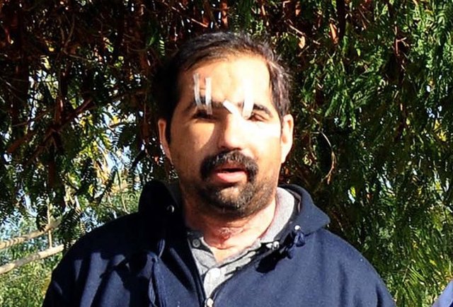 Prof. Dr. Özkan, ameliyatın tamamlanmasının ardından gazetecilere yaptığı açıklamada, Üslün'ün daha önce nakledilen yüzünde bir problem olmadığını ama beklenirse olacağını düşündüklerini söyledi. -