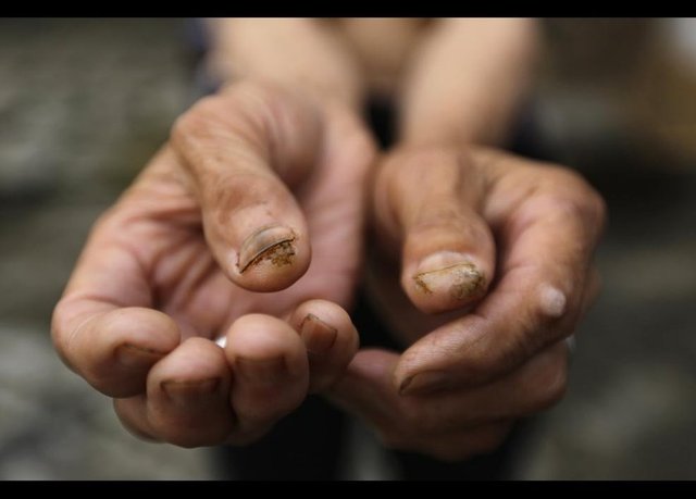 Deri kanseriyle mücadele eden yaşlı kadının parmaklarında bile tümör oluşmuş durumda.