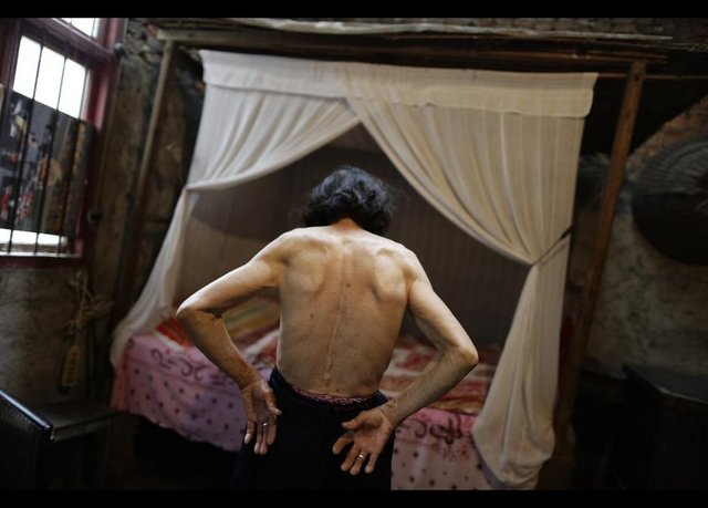 Kanser tedavisi gören 78 yaşındaki Qin Zhengyu, Reuters foto muhabiri Jason Lee'nin objektifine sırtındaki yara ve tümörleri gösteriyor.