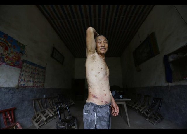 Gong Zhaoyun'a da deri kanseri teşhisi konuldu. -