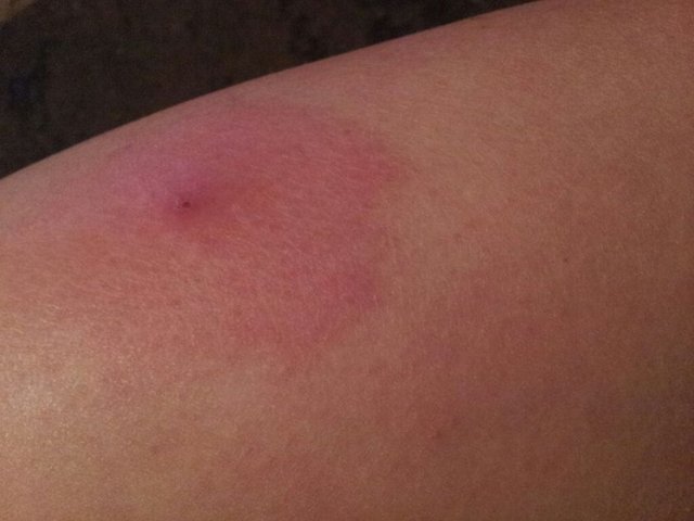 Vücudunuzun herhangi bir yerinde oluşan batık ve kıl dönmesi gibi durumlarda yapacağınız yanlış bir hamle, o bölgede kalıcı yara izlerine yol açacaktır. Bu da en büyük hatalardan biridir.