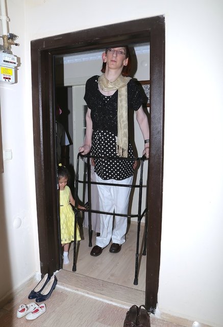 İri bebek olarak 5 kilo 900 gram ağırlığında ve 59 santimetre olarak doğan Gelgi'ye 2 aylıkken kalbinde delik olduğu söylendi. Boyu ve kilosu hızla artan Rümeysa, 26 kiloya ulaştığı 1 yaşında kalp ameliyatı geçirdi.