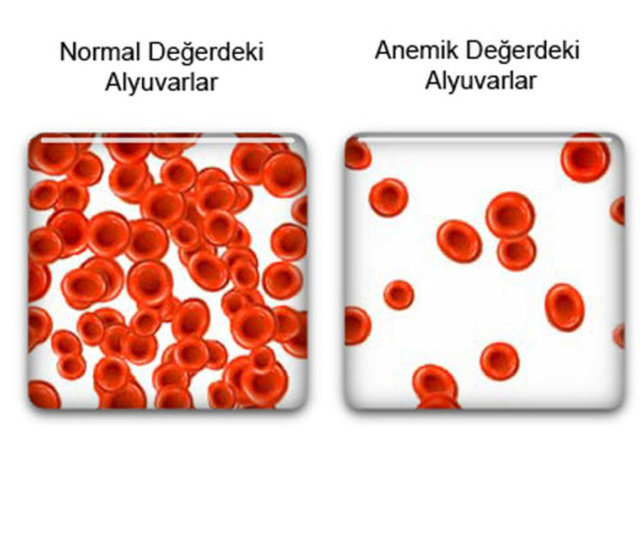 Kadınlarda, gebeliklerde ve çocuklarda daha sık görülür.