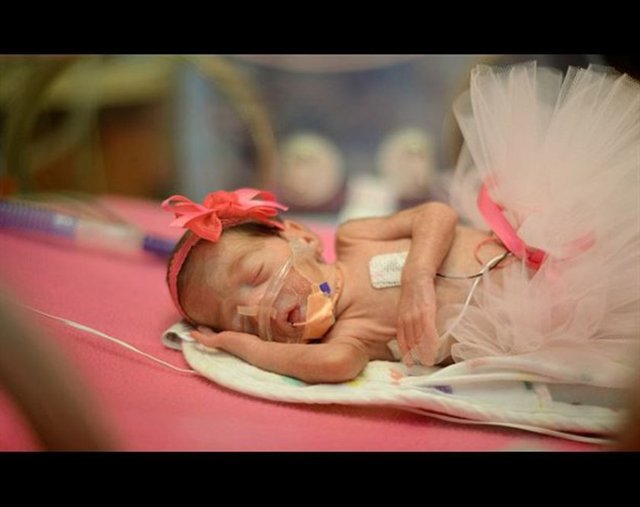 27 haftalık doğan zaman Haley bebek sadece 623 gram ağırlığındaydı -  - 84 gün boyunca yoğun bakım merkezinde kaldı