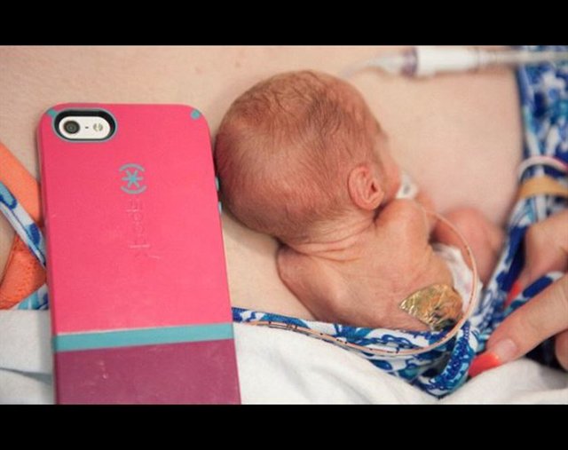 Adeline -  - Doğduğu zaman sadece 425 gram ağırlığındaydı