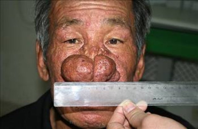 52 yıl boyunca her gün 2 litre brandy içen 68 yaşındaki Liu Ge, "rhinophyma" denilen burundaki kan damarlarının sürekli olarak şişmesine yol açan bir hastalığa yakalandı.