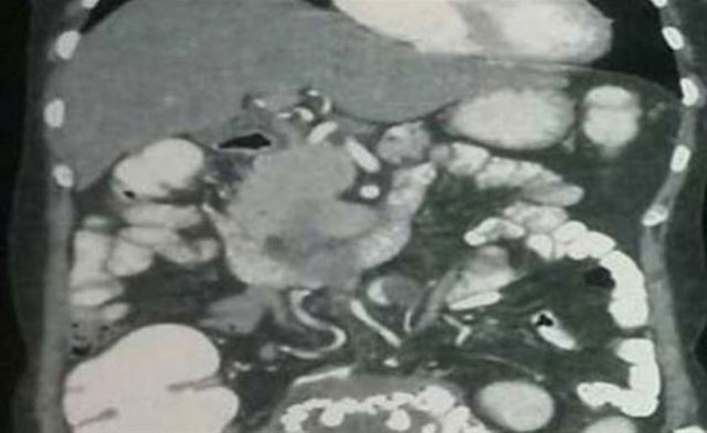 Aylardır yoğun karın ağrıları ve ateş çeken kadın ameliyata alındığında, bir bebeğe ait olduğu sonradan anlaşılan çok sayıda insan kemiği ile karşılaşıldı.