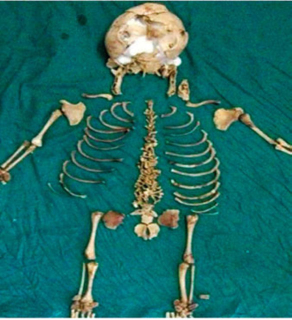 Hindistan'ın orta kesimindeki Madya Pradeş Eyaleti'nde yaşayan 60 yaşındaki Kantabai Gunvant Thakre'nin karnından bir bebek iskeleti çıktı.