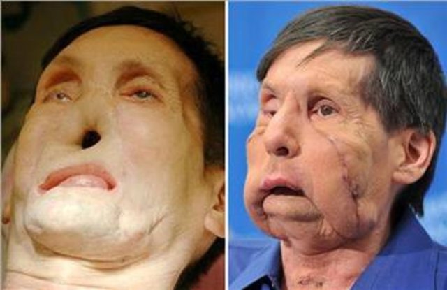 59 yaşındaki James Maki, ikinci yüz nakli operasyonunu geçiren kişi oldu. 17 saatlik operasyon geçiren hasta, metro kazasında yaralanmıştı.