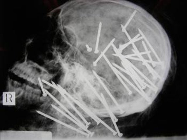 27 yaşındaki Chen'in cesedini inceleyen uzmanlar, büyük şok yaşadı. Chen'in kafatasının röntgeni çekildiğinde kafasına bir sürü çivi çakılmış olduğu görüldü. İncelemeden sonra Chen'in çivi tabancası ile öldürüldüğü anlaşıldı.