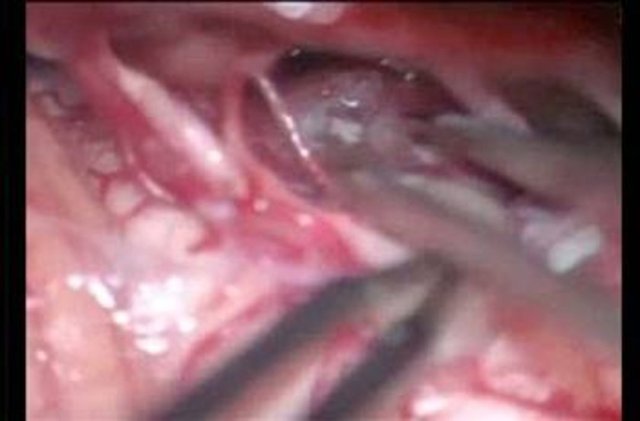 Beyninden solucan çıktı -  - Amerika Arizona eyaletinde beyninde tümör olduğu düşünülen bir kadın ameliyat edilince, tümör sandıkları şeyin canlı bir solucan olduğu anlaşıldı. Operasyonun şokunu atlatan doktorlar bu durumu şöyle açıkladılar: