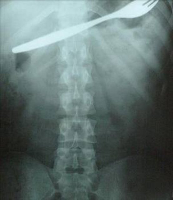 Kahramanmaraş'ın Afşin ilçesinde bir genç kız, karın ağrısı şikayetiyle gittiği hastanede, midesinde çatal olduğunu öğrenince şok oldu. Genç kızın çatalı küçük yaşta yuttuğu sanılırken, çatal başarılı bir ameliyatla çıkarıldı.