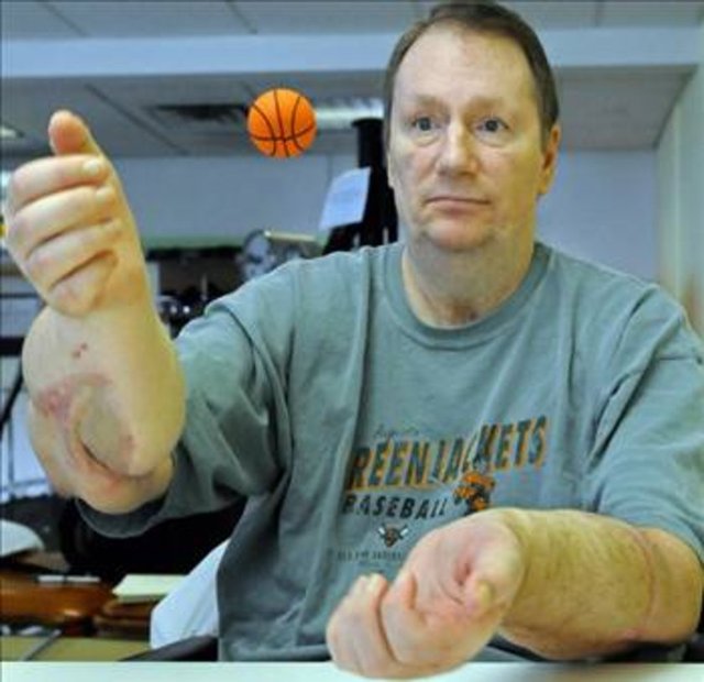 Hem sağ hem sol eli transplant olan Jeff Kepner küçük lastik bir topla antrenman yapıyor.