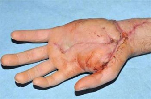 Bir metro kazasında iki elini birden kaybeden hastanın sağ eli sol koluna takıldı. Talihsiz kaza kurbanının sağ eli o kadar kötü yara almıştı ki doktorlar sol ön koluna yapıştırdılar.