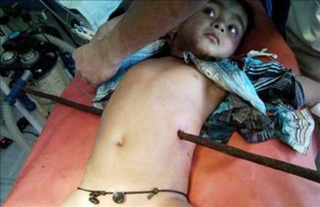 3 yaşındaki bu Hintli çocuk, dini kutlamalar esnasında çatıdan düşmüş ve vücuduna demir çubuk saplanmış.