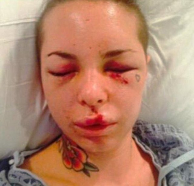 BU HALE GELMİŞTİ - Ringlerde "Savaş Makinesi" adıyla tanınan Jon Koppenhaver isimli dövüşçü tarafından Las Vegas'taki evinde dövülen 23 yaşındaki Mack, hastanede çekilen fotoğraflarını sosyal medyada paylaştı.