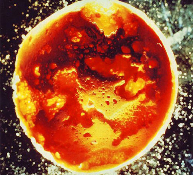 "Romatoid artrit"i yani bağışıklık sisteminin eklemlere saldırmasına yol açan bir bozukluğu olan 50 yaşındaki bir kadının femuru.